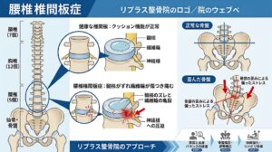 リプラス整骨院の腰椎椎間板症アプローチと骨盤・背骨の歪みの関係性イラスト