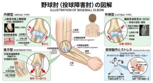野球肘（投球障害肘）の図解。内側型、外側型、後方型の発生メカニズムと投球動作にお けるストレスの解説図
